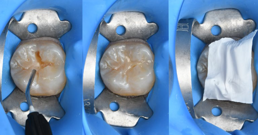 Fig. 9: Restoration procedure: Application of flowable composite.